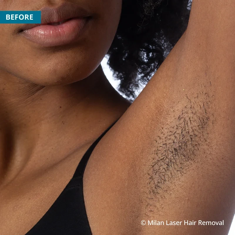 Underarm Before & After Photos of Laser Hair Removal | Milan Laser in  Milwaukee, WI