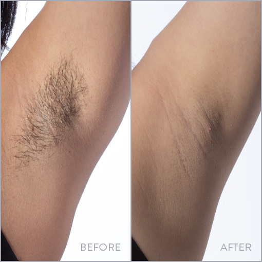 Laser Hair Removal - Penn Medicine Cosmetic Services